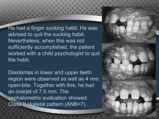 He had a finger sucking habit. He was
advised to quit the sucking habit.
Nevertheless, when this was not
sufficiently accomplished, the patient
worked with a child psychologist to quit
the habit.
Diastemas in lower and upper teeth
region were observed as well as 4 mm.
open-bite. Together with this, he had
an overjet of 7.5 mm. The
cephalometric evaluation showed
Class II skeletal pattern (ANB=7).
99
 
