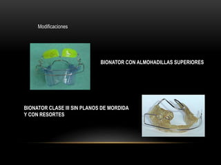 BIONATOR CON ALMOHADILLAS SUPERIORES
BIONATOR CLASE III SIN PLANOS DE MORDIDA
Y CON RESORTES
Modificaciones
 