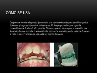 COMO SE USA
Después de insertar el aparato fijar una cita una semana después para ver si hay puntos
dolorosos y luego se cita cada 4 o 6 semanas. El tiempo promedio para lograr la
corrección es de 1 año a 1 año y medio. El mismo aparato se usa para la retención y se
lleva solo durante la noche. La duración del periodo de retención puede variar de 6 meses
a 1 año o más. El aparato se usa cada vez menos de noche.
 