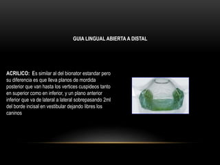ACRILICO: ﻿Es similar al del bionator estandar pero
su diferencia es que lleva planos de mordida
posterior que van hasta los vertices cuspideos tanto
en superior como en inferior, y un plano anterior
inferior que va de lateral a lateral sobrepasando 2ml
del borde incisal en vestibular dejando libres los
caninos
GUIA LINGUAL ABIERTA A DISTAL
 
