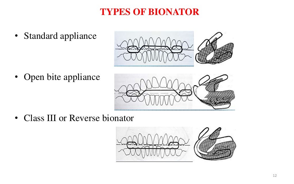Bionator and frankel appliances in orthodontics