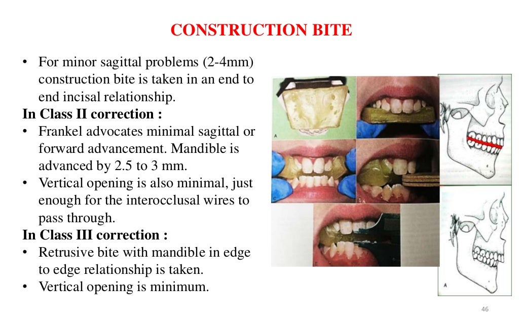 Bionator and frankel appliances in orthodontics