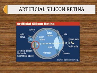 ARTIFICIAL SILICON RETINA
 