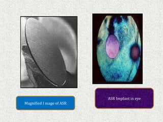 Magnified I mage of ASR
ASR Implant in eye
 
