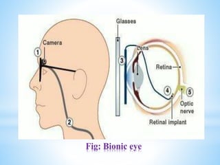 Fig: Bionic eye
 