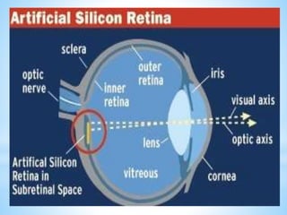 A. Artificial silicon retina
Artificial Silicon Retina (ASR) is a solid state
biocompatible chip which contains an array of
photoreceptors, and is implanted to replace the functionality
of the defective photoreceptor.
 