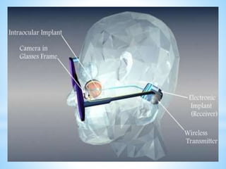 B. The MARC system
The MARC system are a power and signal transceiver
and processing chip, a stimulation- current driver , and
a proposed electrode array fabricating on a material
such as silicone rubber,thin silicone or polyimide with
a ribbon cables connecting the device.
 