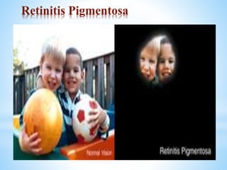 Retinitis Pigmentosa
Hereditary Genetic Disease
Peripheral Rods degenerate
Gradually progresses towards center of eye
Spares the foveal region
Tunnel vision results
 