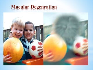 Macular Degenration
Genetically Related
Cones in Macula region degenrate
Loss or damage of central vision
Peripheral Retina spared
Common among old people
 