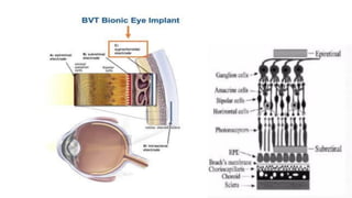 Bionic Eye Technology: Innovations in Restoring Vision and Fighting ...
