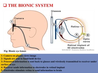 Bionic Eye | PPTX
