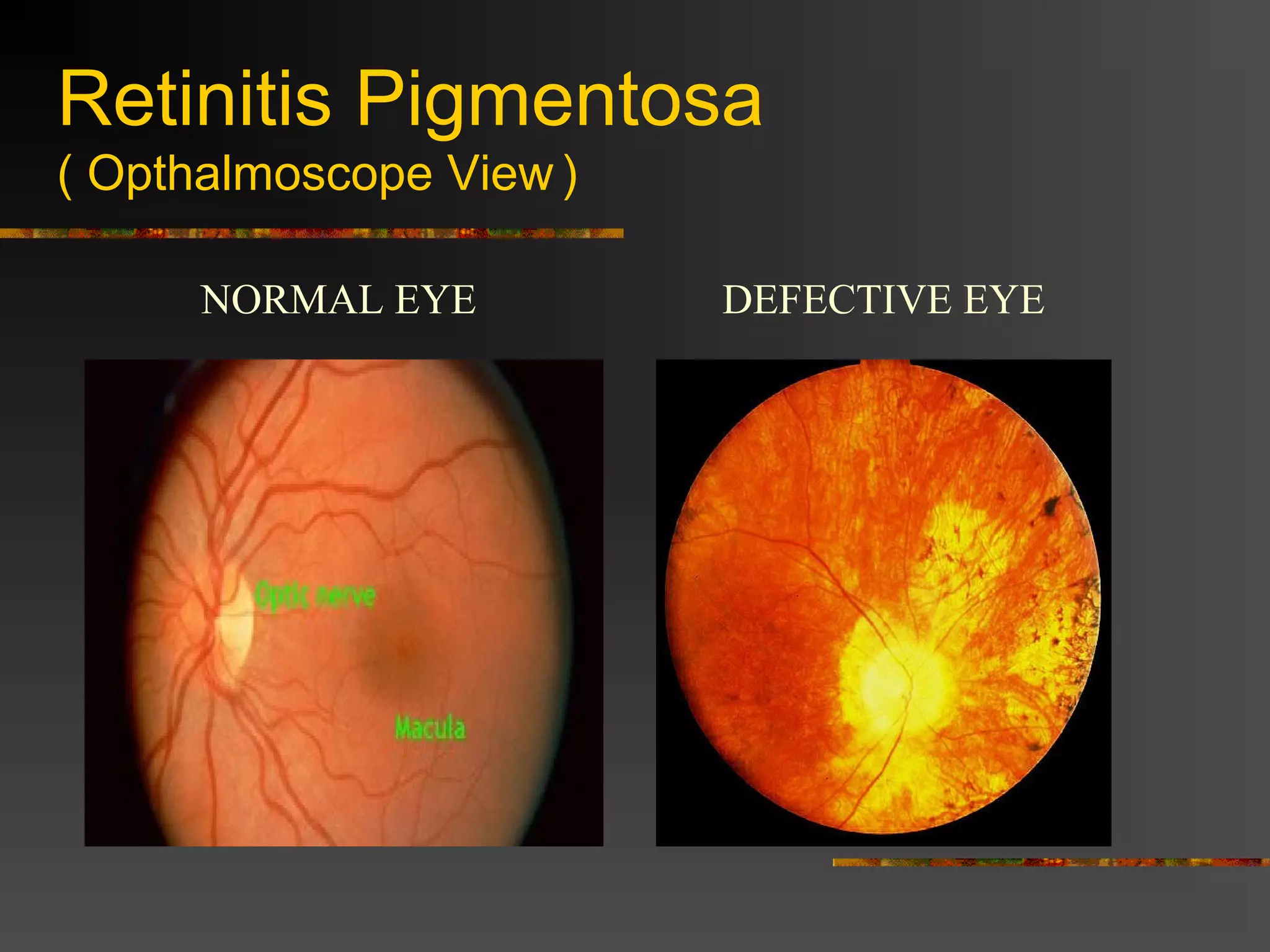 Retinitis Pigmentosa
( Opthalmoscope View)
NORMAL EYE DEFECTIVE EYE
 