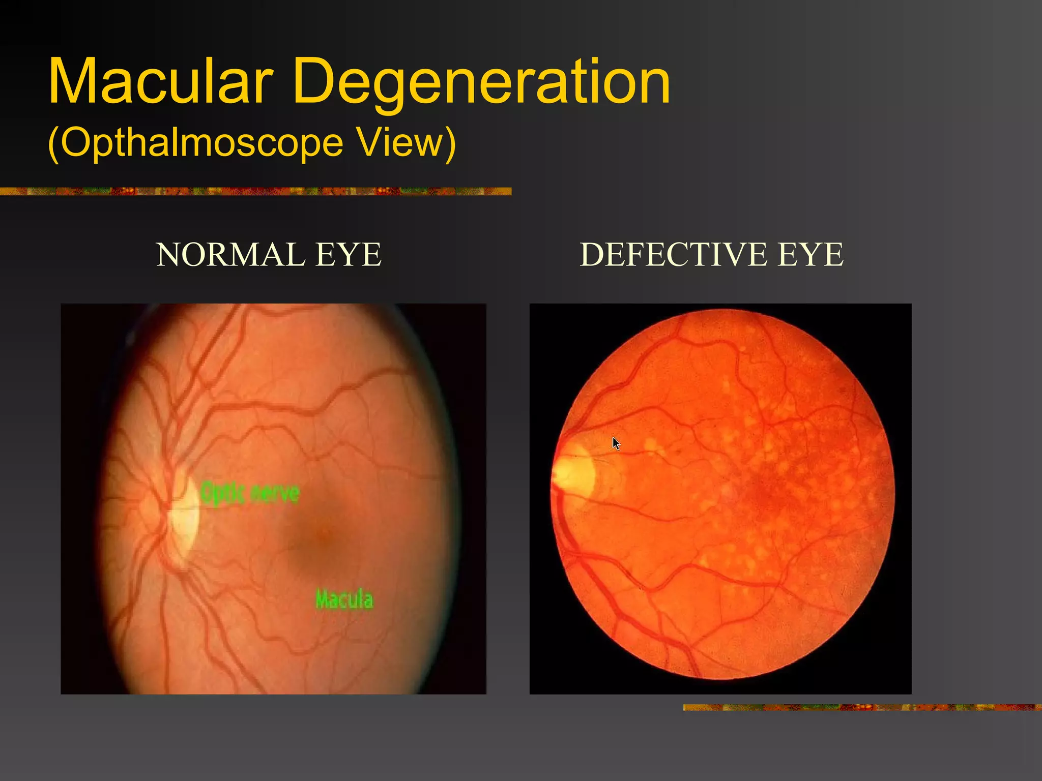 Macular Degeneration
(Opthalmoscope View)
NORMAL EYE DEFECTIVE EYE
 