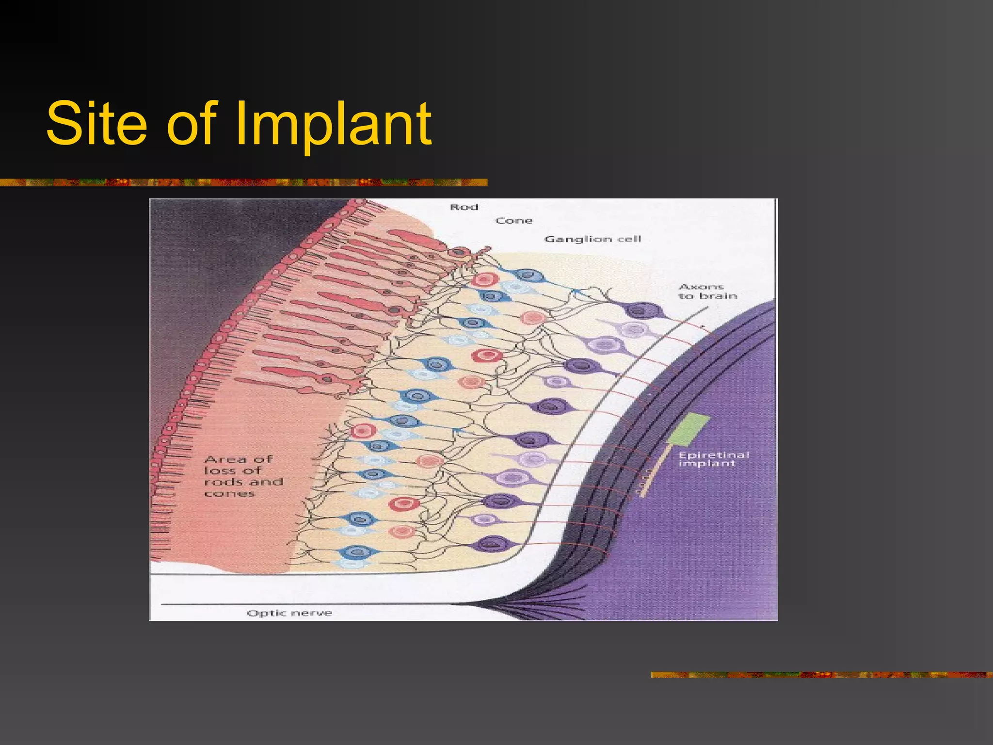 Site of Implant
 