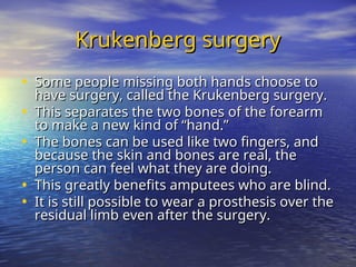 Krukenberg surgery
Krukenberg surgery
• Some people missing both hands choose to
Some people missing both hands choose to
have surgery, called the Krukenberg surgery.
have surgery, called the Krukenberg surgery.
• This separates the two bones of the forearm
This separates the two bones of the forearm
to make a new kind of “hand.”
to make a new kind of “hand.”
• The bones can be used like two fingers, and
The bones can be used like two fingers, and
because the skin and bones are real, the
because the skin and bones are real, the
person can feel what they are doing.
person can feel what they are doing.
• This greatly benefits amputees who are blind.
This greatly benefits amputees who are blind.
• It is still possible to wear a prosthesis over the
It is still possible to wear a prosthesis over the
residual limb even after the surgery.
residual limb even after the surgery.
 