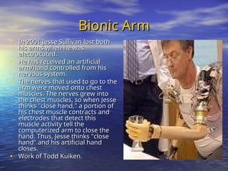 Bionic Arm
Bionic Arm
• In 2001 Jesse Sullivan lost both
In 2001 Jesse Sullivan lost both
his arms when he was
his arms when he was
electrocuted.
electrocuted.
• He has received an artificial
He has received an artificial
arm/hand controlled from his
arm/hand controlled from his
nervous system.
nervous system.
• The nerves that used to go to the
The nerves that used to go to the
arm were moved onto chest
arm were moved onto chest
muscles. The nerves grew into
muscles. The nerves grew into
the chest muscles, so when Jesse
the chest muscles, so when Jesse
thinks "close hand," a portion of
thinks "close hand," a portion of
his chest muscle contracts and
his chest muscle contracts and
electrodes that detect this
electrodes that detect this
muscle activity tell the
muscle activity tell the
computerized arm to close the
computerized arm to close the
hand. Thus, Jesse thinks "close
hand. Thus, Jesse thinks "close
hand" and his artificial hand
hand" and his artificial hand
closes.
closes.
• Work of Todd Kuiken.
Work of Todd Kuiken.
 