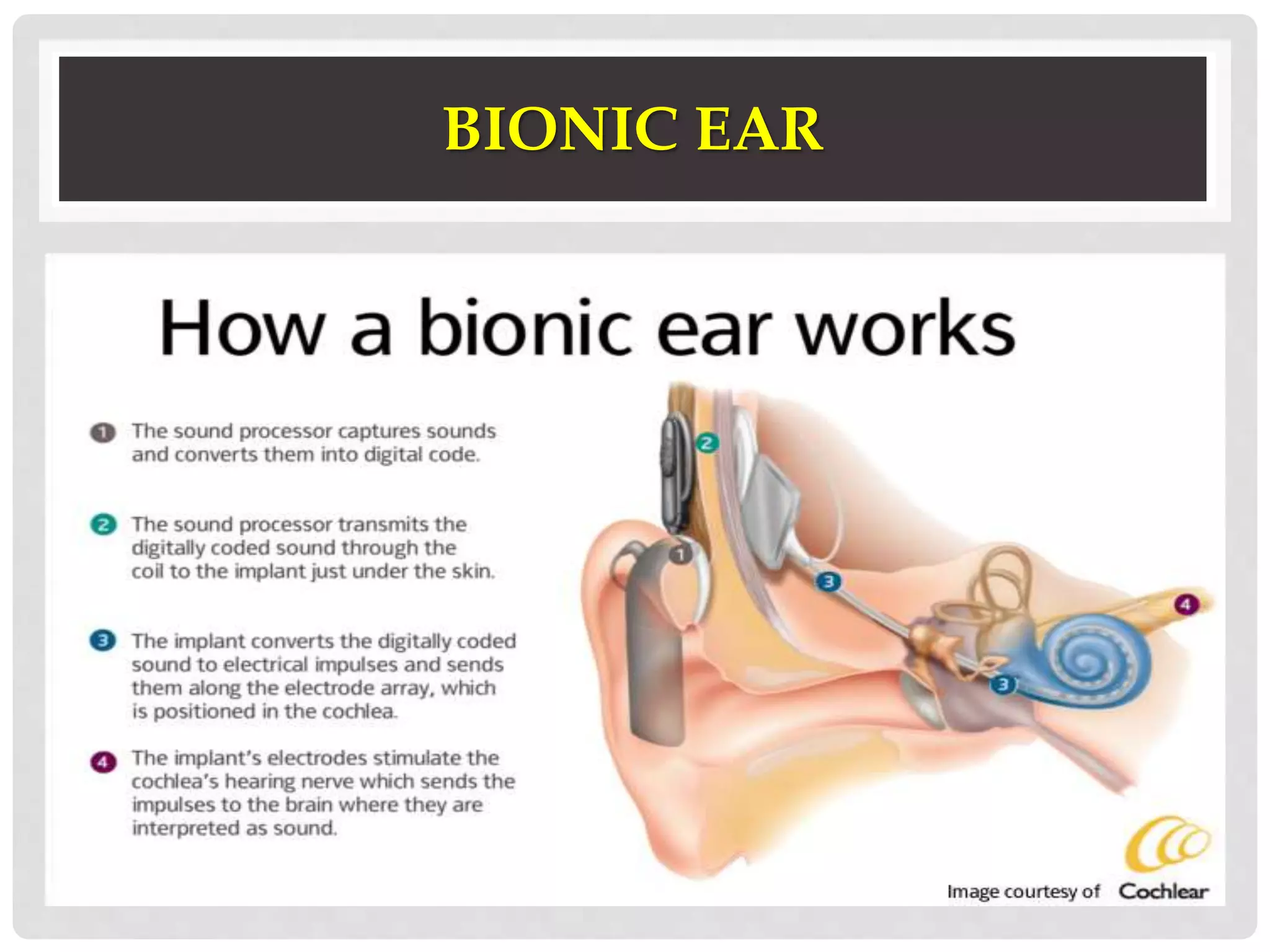 BIONIC EAR 
 