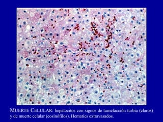 MUERTE CELULAR: hepatocitos con signos de tumefacción turbia (claros)
y de muerte celular (eosinófilos). Hematíes extravasados.
 