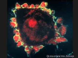 QUERATINOCITO: ZEIOSIS
 