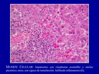 MUERTE CELULAR: hepatocitos con citoplasma eosinófilo y núcleo
picnótico; otros, con signos de tumefacción. Infiltrado inflamatorio (Ii).
Ii
 