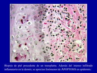 Biopsia de piel procedente de un transplante. Además del intenso infiltrado
inflamatorio en la dermis, se aprecian fenómenos de APOPTOSIS en epidermis.
 