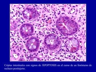 Criptas intestinales con signos de APOPTOSIS en el curso de un fenómeno de
rechazo postinjerto.
 