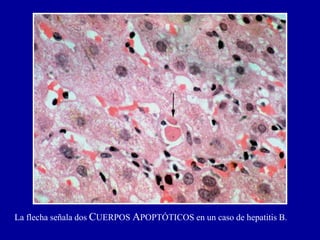 La flecha señala dos CUERPOS APOPTÓTICOS en un caso de hepatitis B.
 