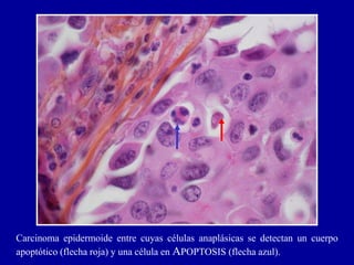 Carcinoma epidermoide entre cuyas células anaplásicas se detectan un cuerpo
apoptótico (flecha roja) y una célula en APOPTOSIS (flecha azul).
 