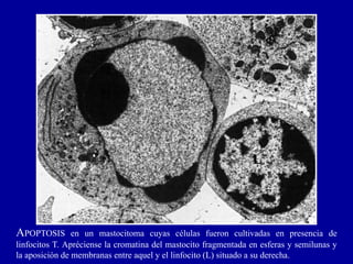 APOPTOSIS en un mastocitoma cuyas células fueron cultivadas en presencia de
linfocitos T. Apréciense la cromatina del mastocito fragmentada en esferas y semilunas y
la aposición de membranas entre aquel y el linfocito (L) situado a su derecha.
L
 