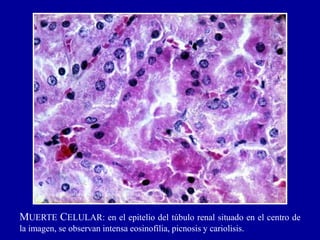 MUERTE CELULAR: en el epitelio del túbulo renal situado en el centro de
la imagen, se observan intensa eosinofilia, picnosis y cariolisis.
 