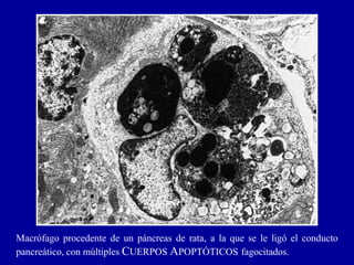 Macrófago procedente de un páncreas de rata, a la que se le ligó el conducto
pancreático, con múltiples CUERPOS APOPTÓTICOS fagocitados.
 