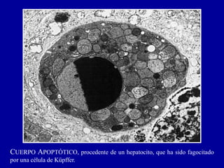 CUERPO APOPTÓTICO, procedente de un hepatocito, que ha sido fagocitado
por una célula de Küpffer.
 