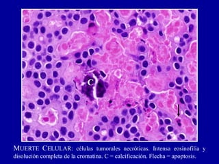 MUERTE CELULAR: células tumorales necróticas. Intensa eosinofilia y
disolución completa de la cromatina. C = calcificación. Flecha = apoptosis.
C
 