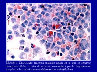 MUERTE CELULAR: leucemia mieloide aguda en la que se observan
numerosas células en vías de necrosis, reconocibles por la fragmentación
irregular de la cromatina de sus núcleos (cariorrexis) (flechas).
 