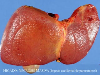 HIGADO: NECROSIS MASIVA (ingesta accidental de paracetamol)
 