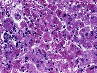 HIGADO: NECROSIS MASIVA (ingesta accidental de paracetamol)
 