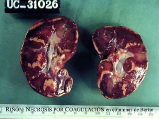 RIÑÓN: NECROSIS POR COAGULACIÓN en columnas de Bertin
 