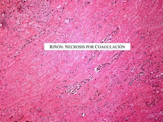 RIÑÓN: NECROSIS POR COAGULACIÓN
 
