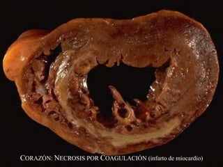 CORAZÓN: NECROSIS POR COAGULACIÓN (infarto de miocardio)
 