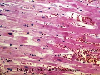 INFARTO DE MIOCARDIO (24 h de evolución)
 