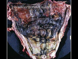 ESTÓMAGO: QUEMADURAS POR CÁUSTICO
 