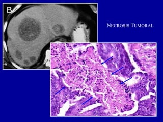 NECROSIS TUMORAL
 