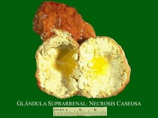 GLÁNDULA SUPRARRENAL: NECROSIS CASEOSA
 