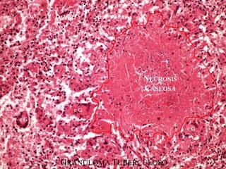 NECROSIS
CASEOSA
c G
GRANULOMA TUBERCULOSO
c G
c G
c G
 