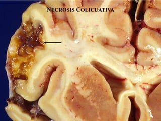 NECROSIS COLICUATIVA
 