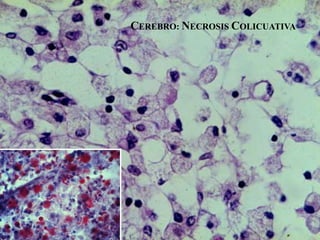 CEREBRO: NECROSIS COLICUATIVA
 