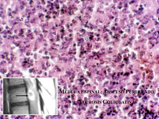 MÉDULA ESPINAL: ABSCESO PURULENTO
NECROSIS COLICUATIVA
 