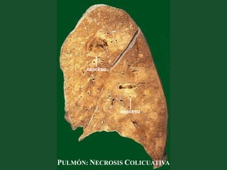 ABSCESO
ABSCESO
PULMÓN: NECROSIS COLICUATIVA
 