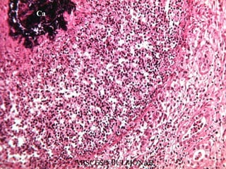 ABSCESO PULMONAR
Ca
 