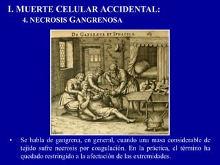 I. MUERTE CELULAR ACCIDENTAL:
4. NECROSIS GANGRENOSA
• Se habla de gangrena, en general, cuando una masa considerable de
tejido sufre necrosis por coagulación. En la práctica, el término ha
quedado restringido a la afectación de las extremidades.
 